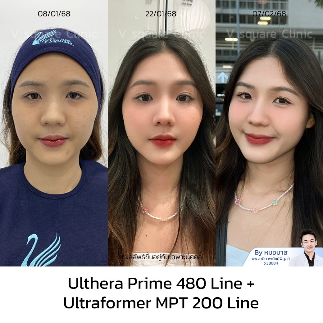 Ultherapy Prime review_เอิร์น UL RR+MPT โดย หมอ บาส