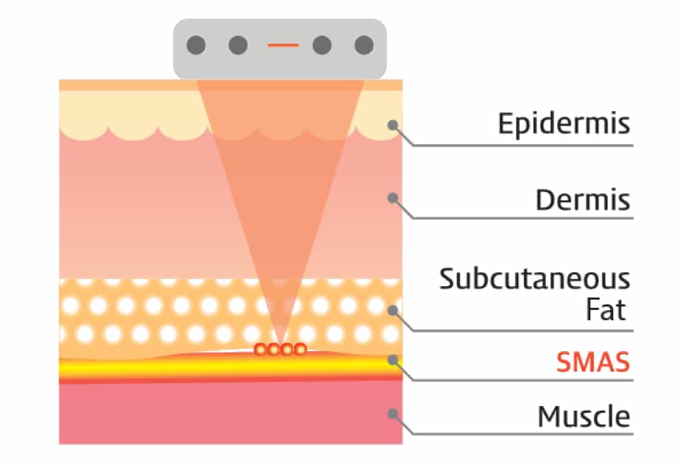 What are the benefits of the SMAS layer