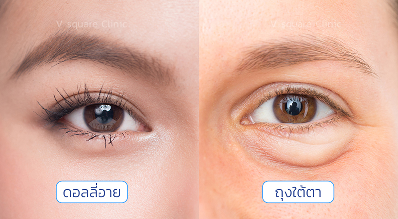 Dolly Eyes vs. Under-Eye Bags