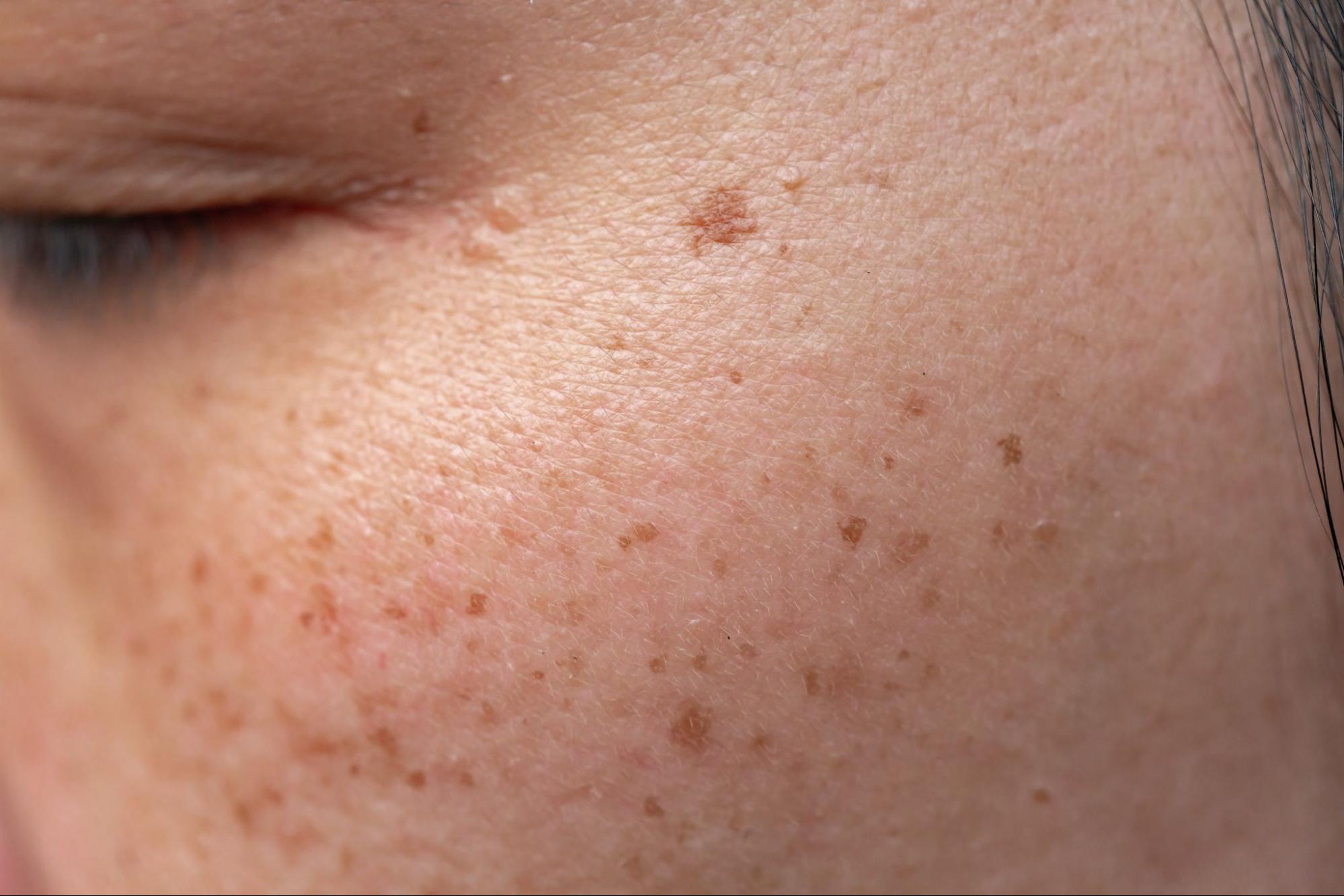 Who Is Pico Plus Laser Suitable For