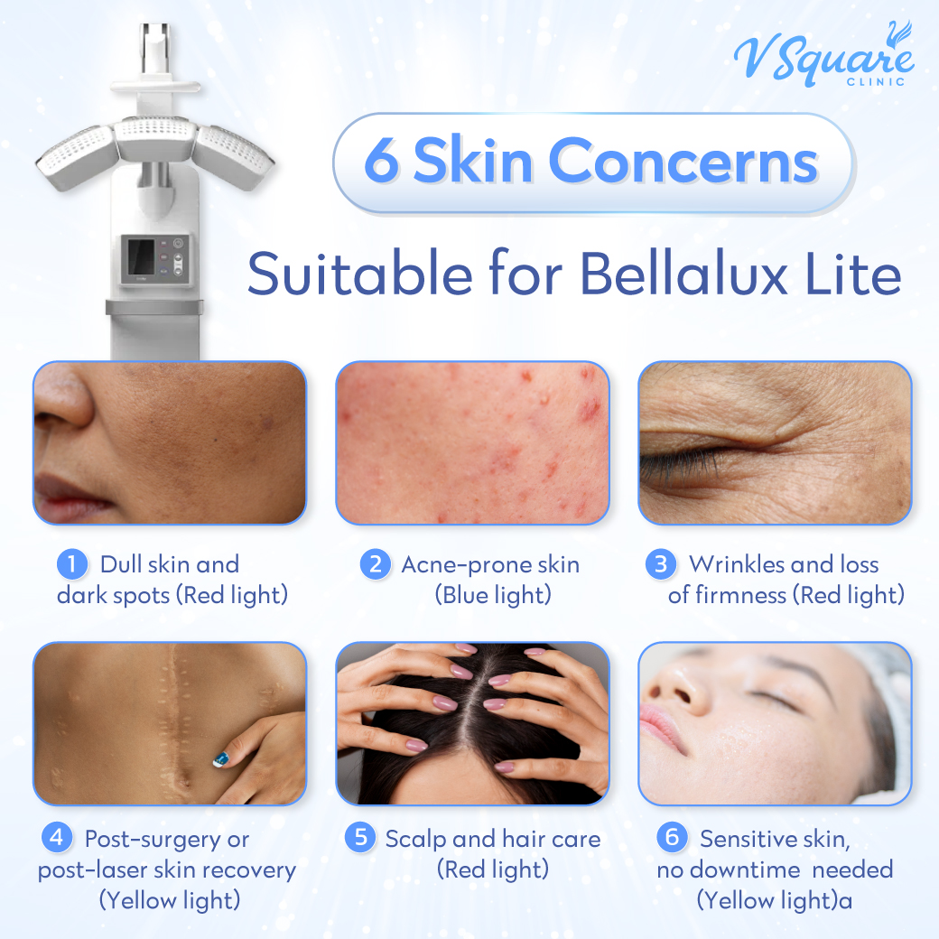 Bellalux Lite pore-tightening laser