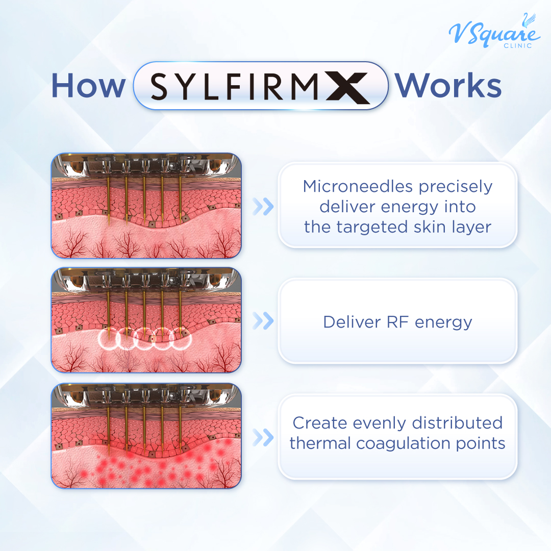 Sylfirm X Plus pore-tightening laser