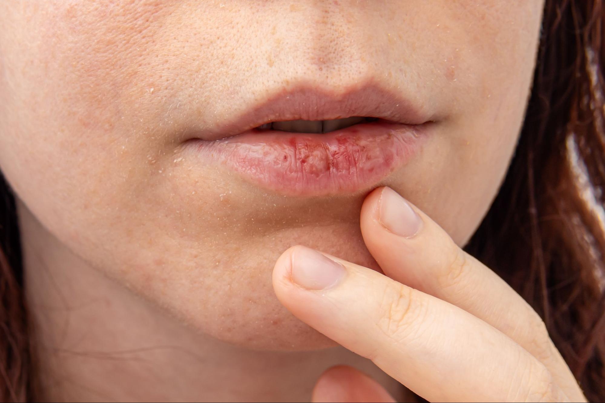 Are dry lips dangerous