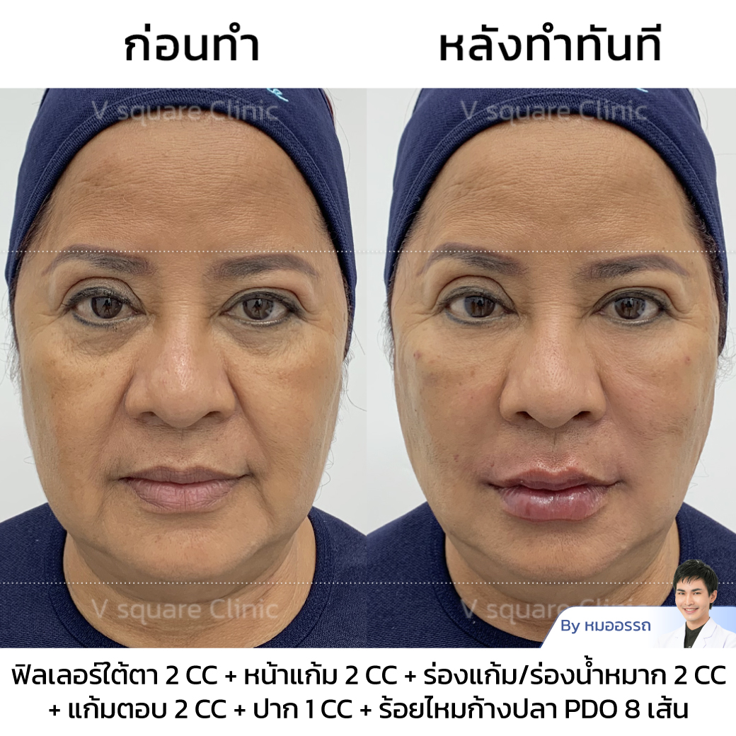 Barbed thread lift review_คุณโนกิ โดย หมอ อรรถ