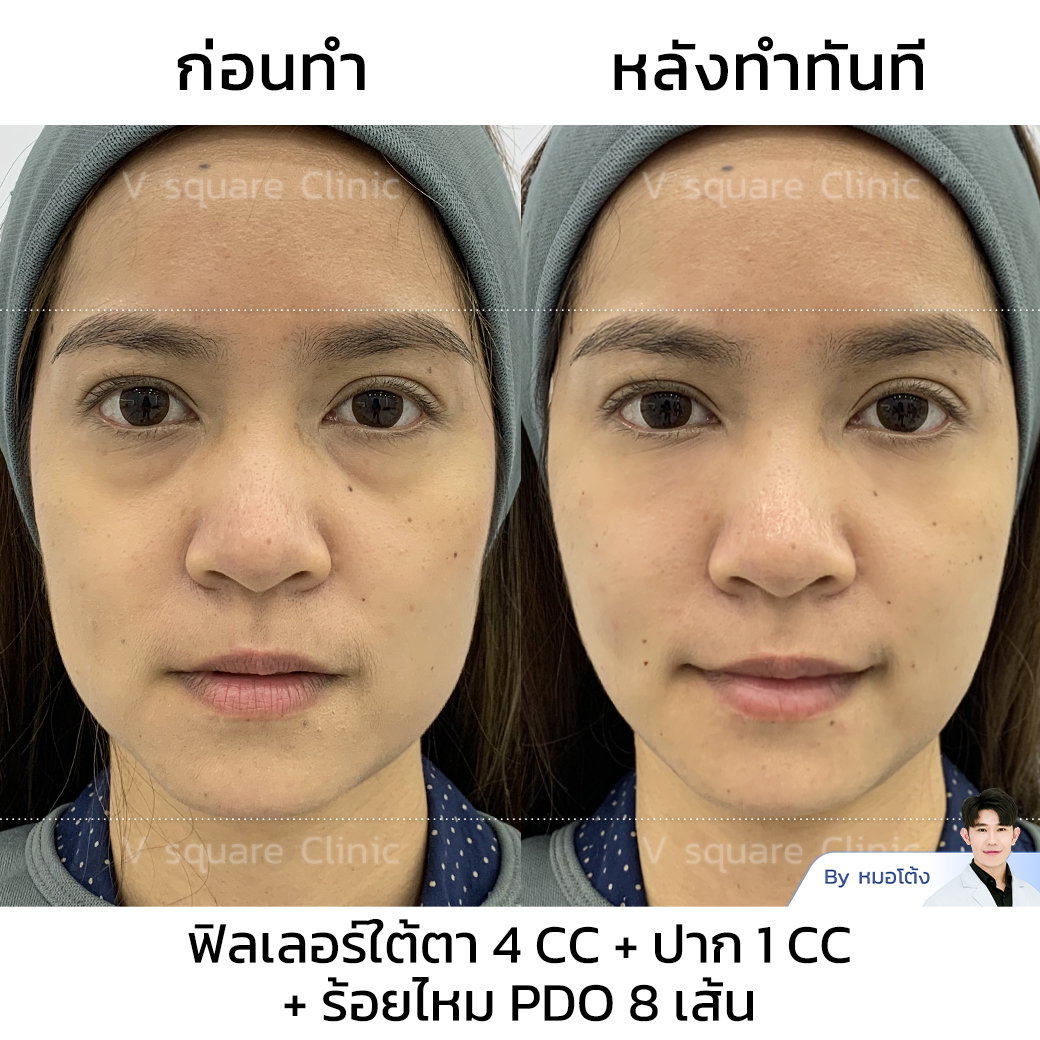 Barbed thread lift review_พี่เก่ง โดย หมอโต้ง