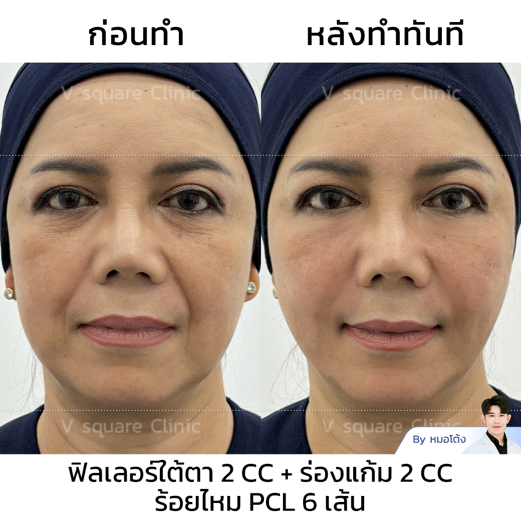 Barbed thread lift review_แม่เปิ้ลInfluencer โดย หมอโต้ง