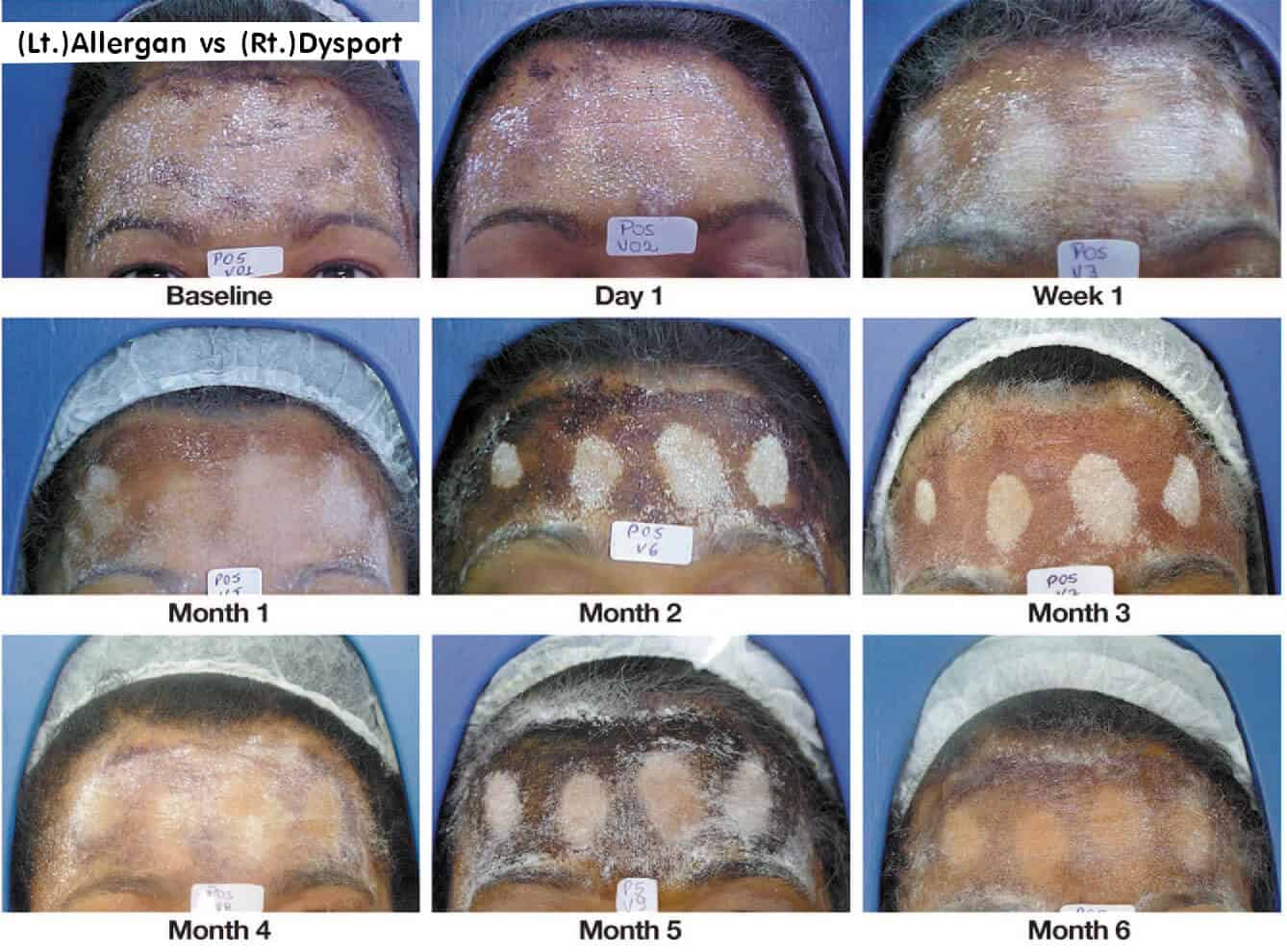 Botox Diffusion Area