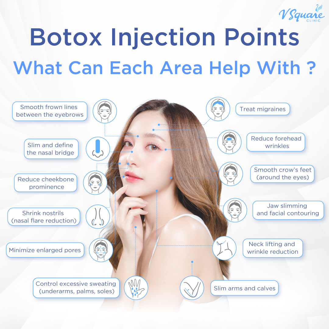 Botox injection points