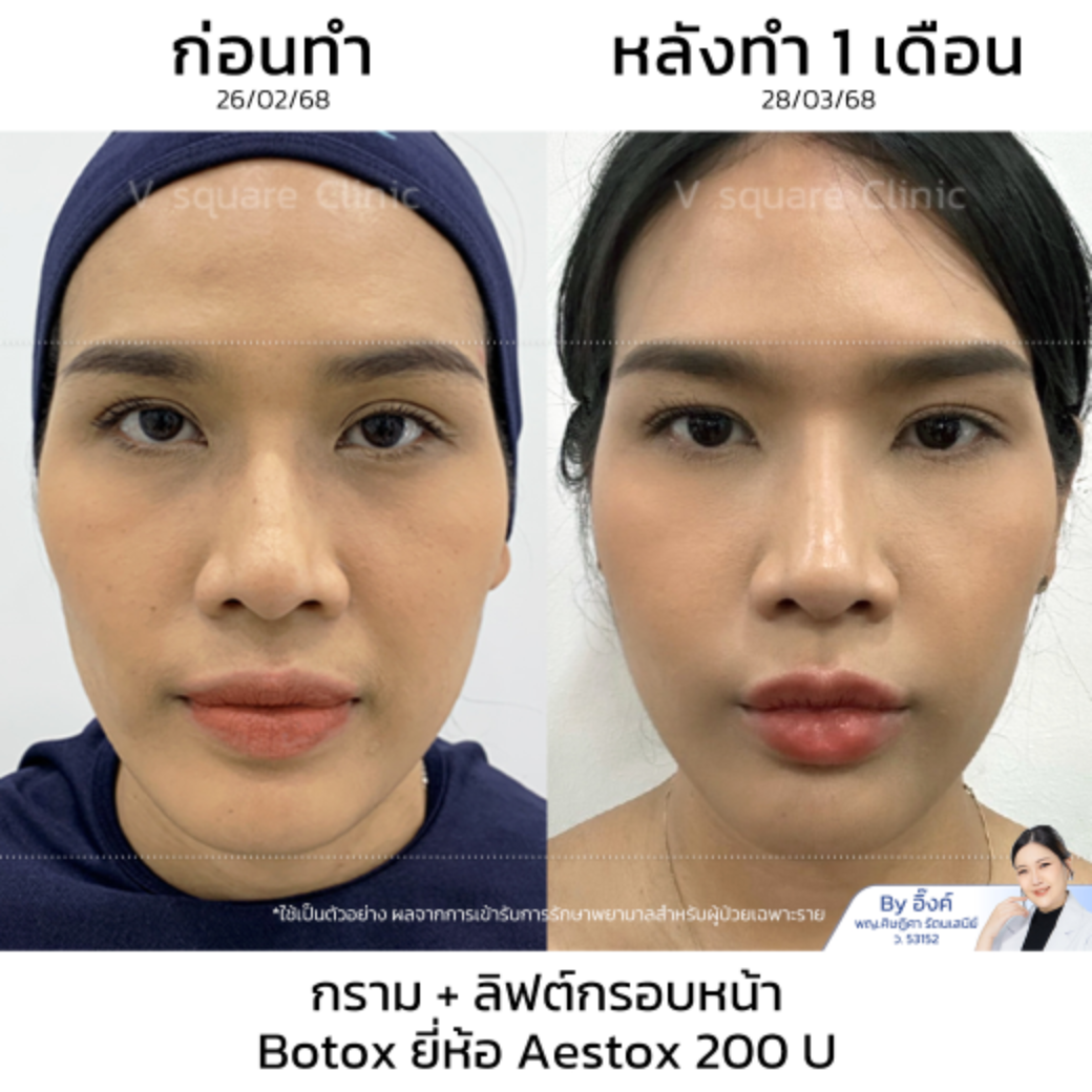 Botox review_คุณกุญแจซอล โดอย หมออิงค์