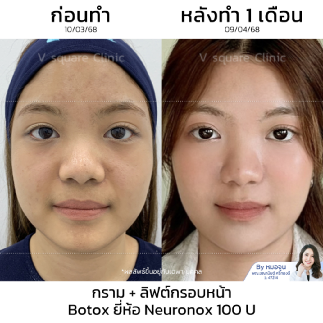Botox review_คุณคาโอริ โดย หมอจูน