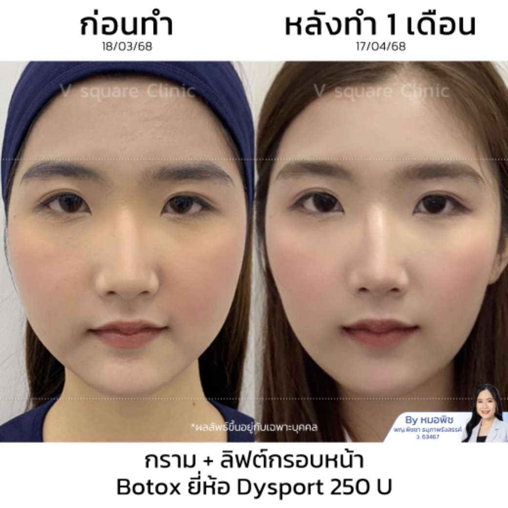 Botox review_คุณคาโอริ โดย หมอพิช