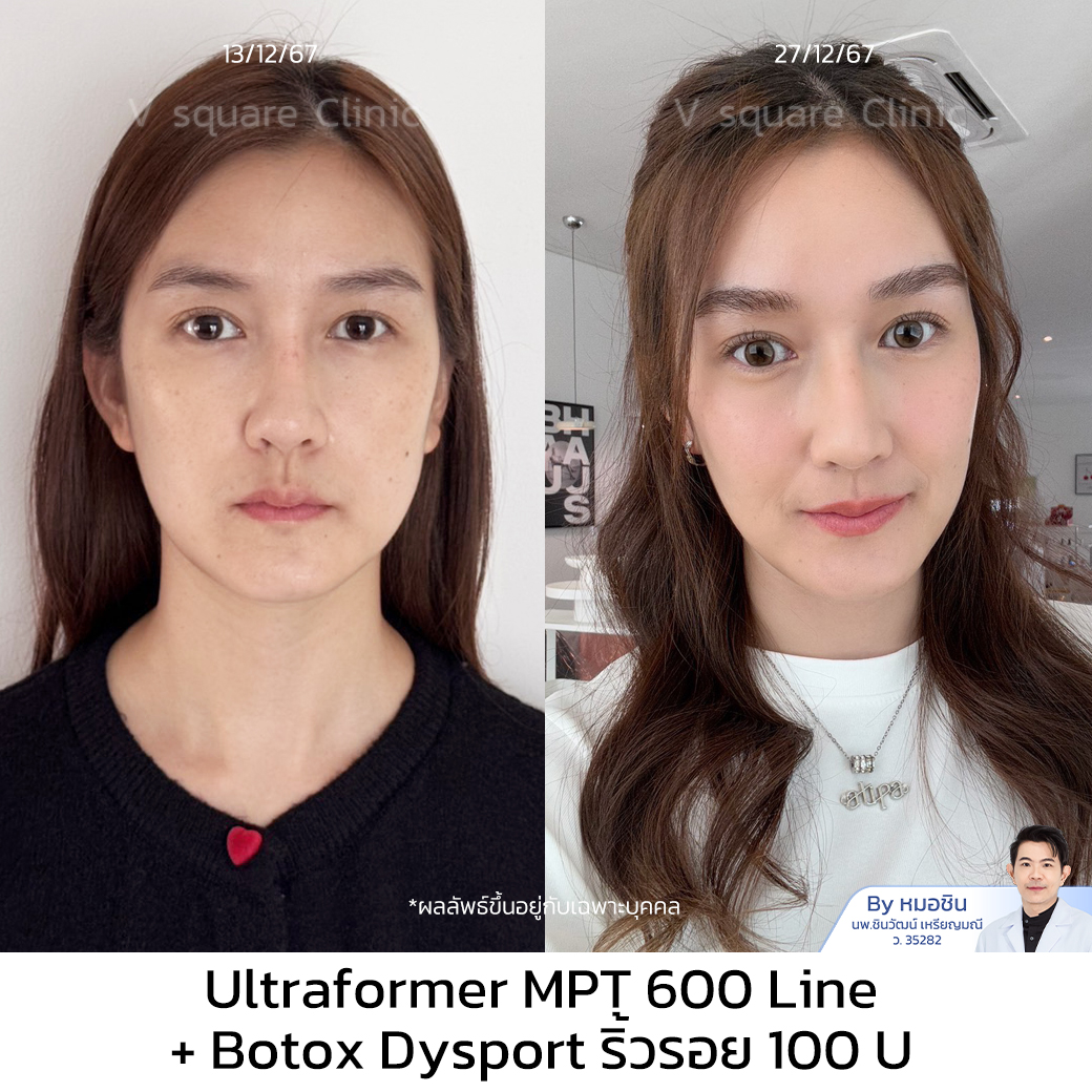 Botox review_คุณจูน โดย หมอชิน