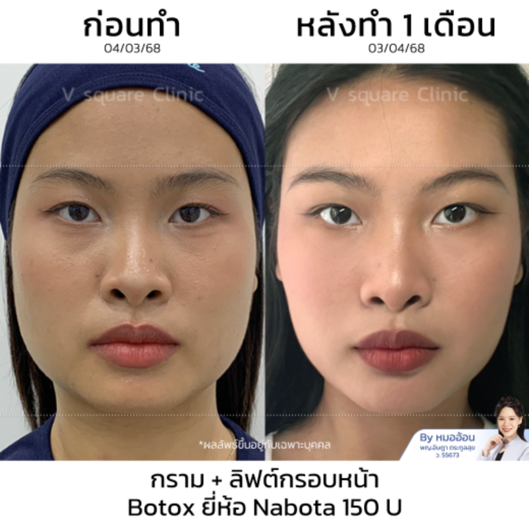 Botox review_คุณญานิน โดย หมอ อ้อน