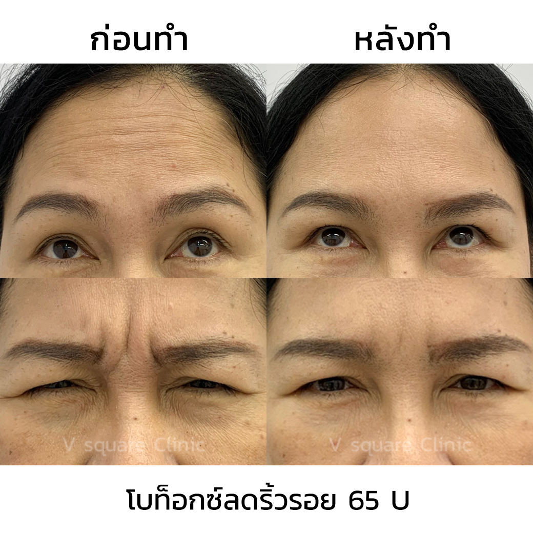 Botox review_คุณป้อม