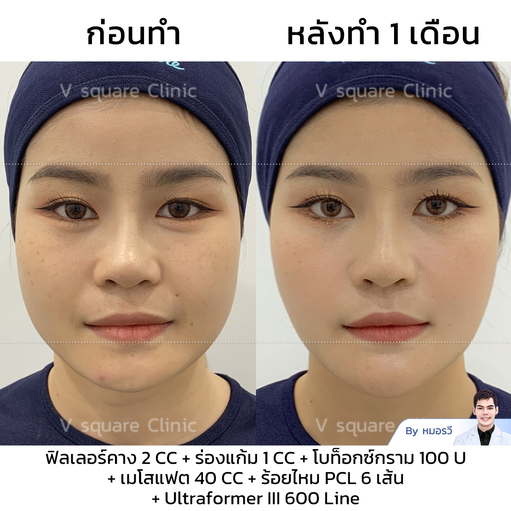 Botox review_คุณหญิง โดย หมอรวี