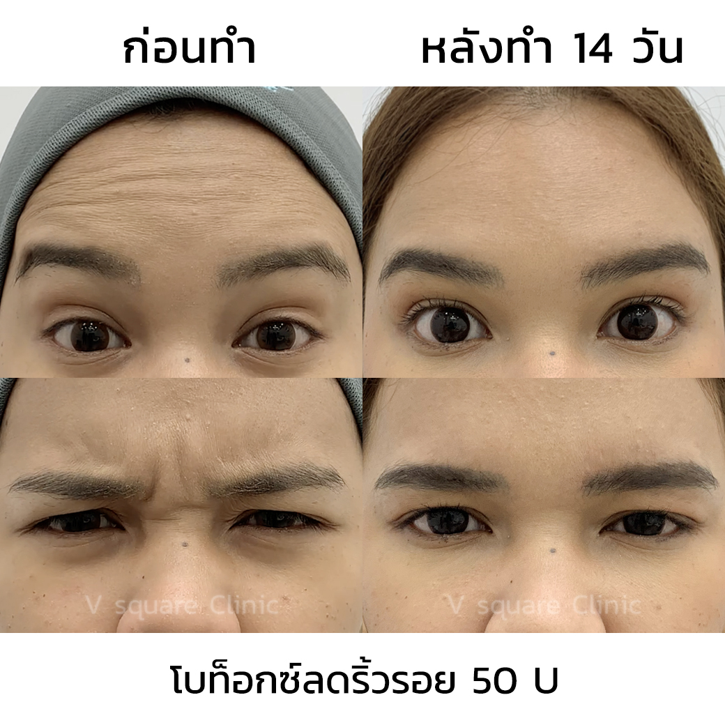 Botox review_มายด์