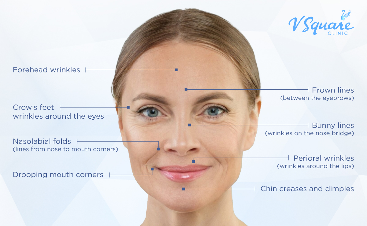Botox wrinkle reduction on the face