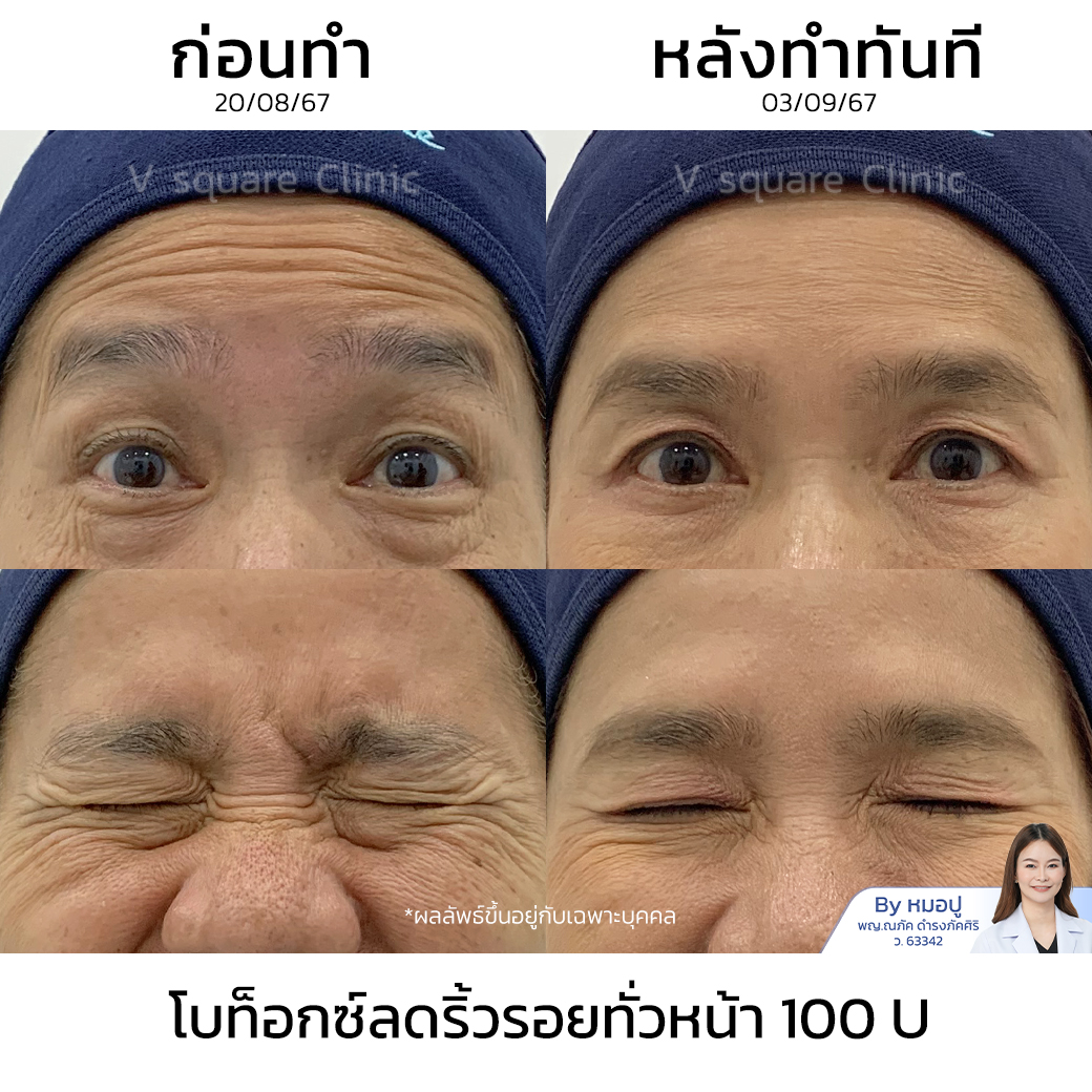 Botox wrinkle reduction review_คุณชมพู่ โดย หมอปู