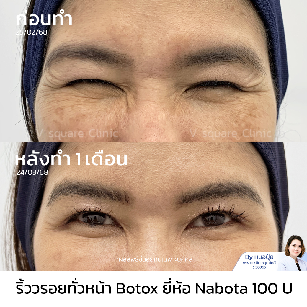 Botox wrinkle reduction review_คุณหมวย โดย หมอ ปุ้ย