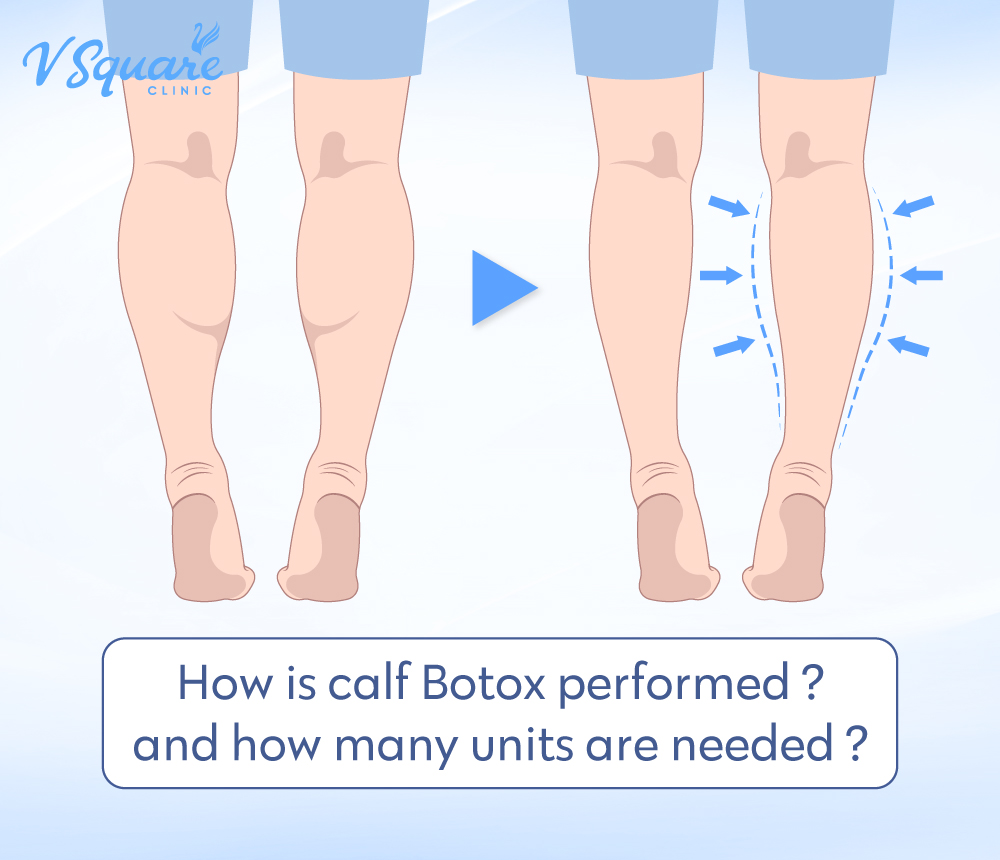 Calf Botox Injection