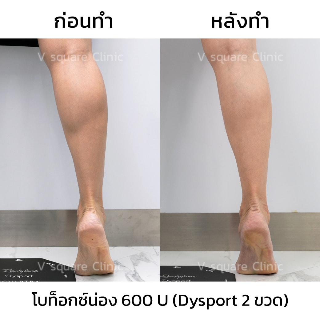 Calf Botox review_คุณแพร