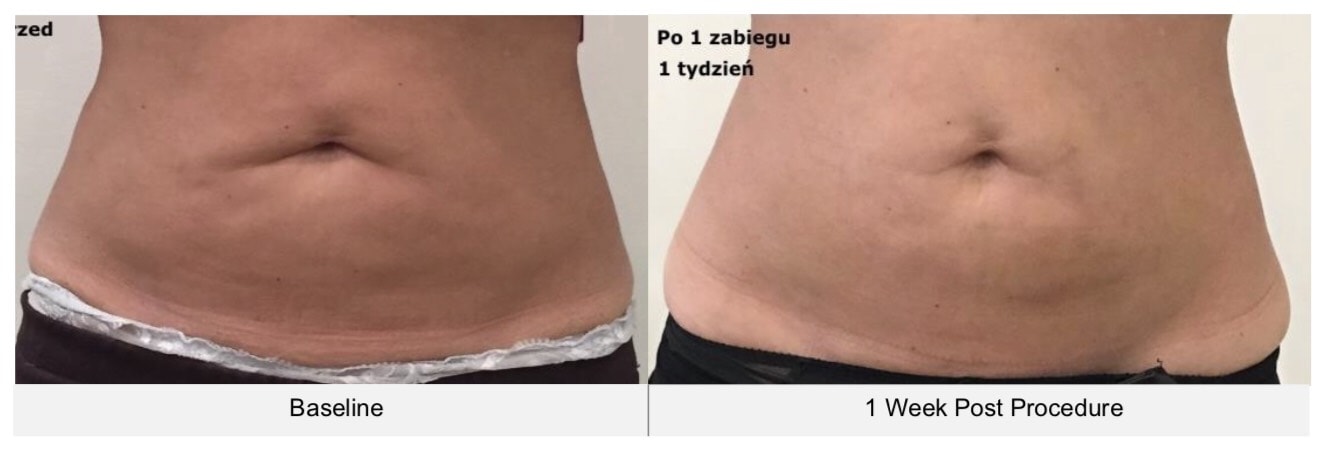 Cellulite abdomen