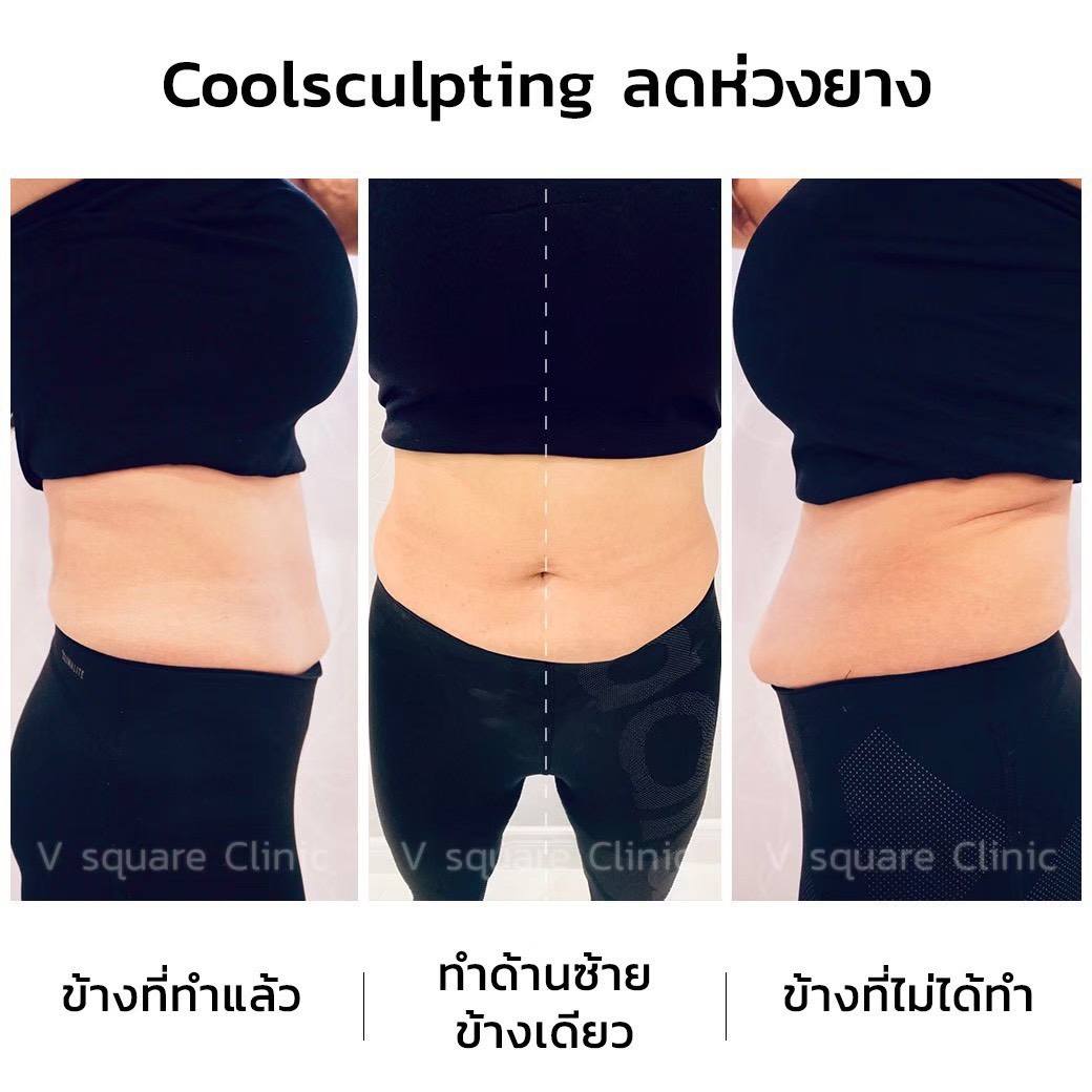CoolSculpting muffin top reduction review