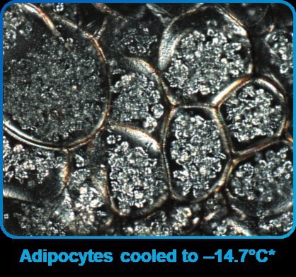 CoolSculpting reduces fat cells in the skin layer