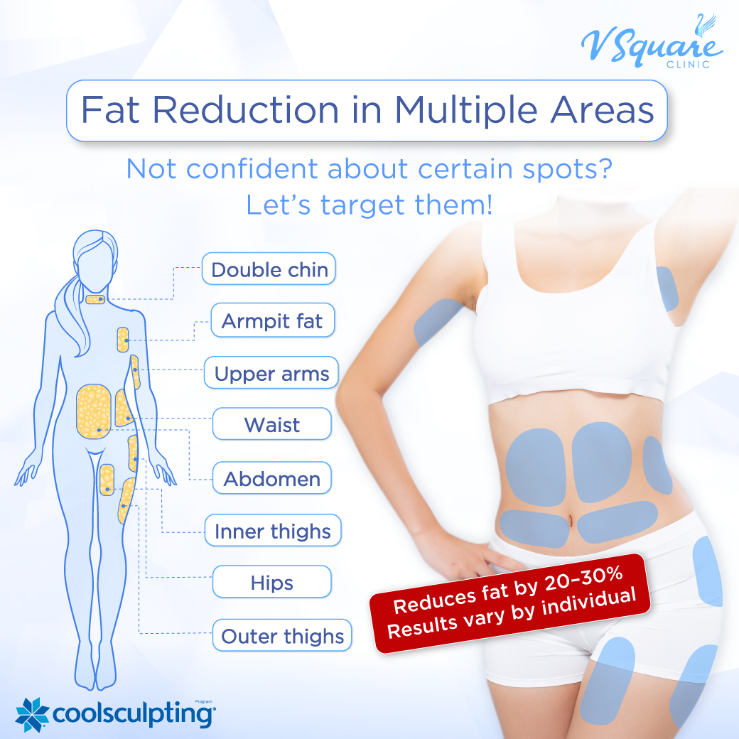 CoolSculpting treatment areas