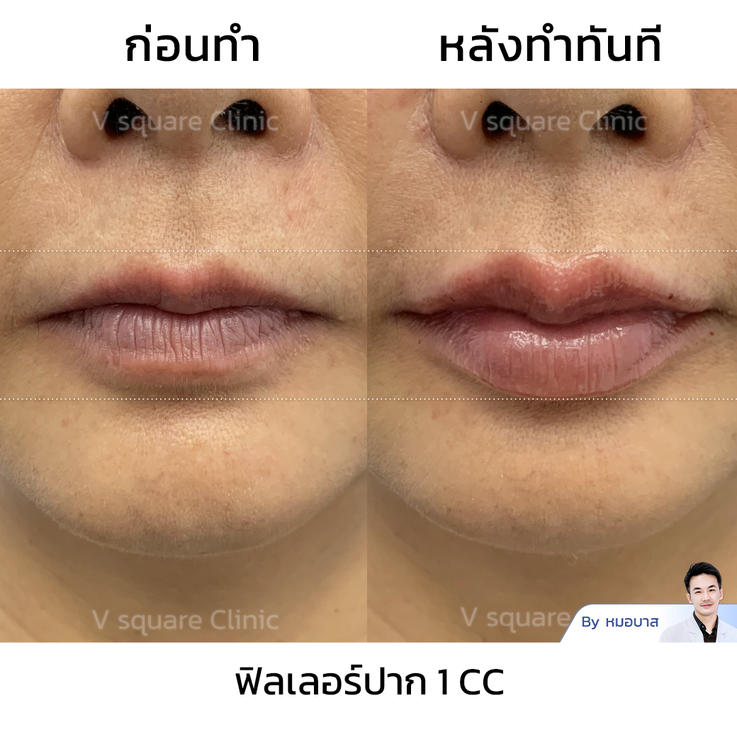 Cupid’s Bow Lips Filler Review โดย หมอบาส