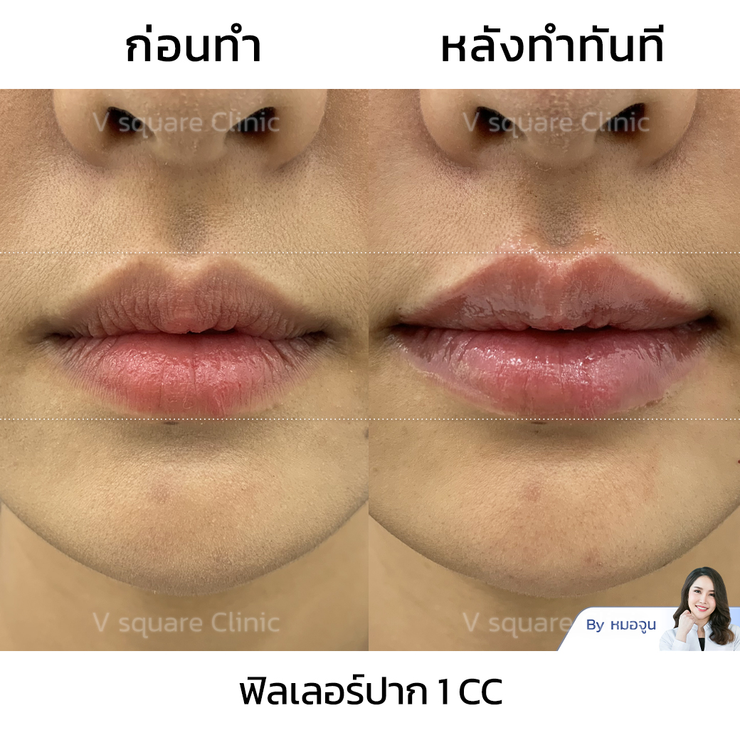 Cupid’s Bow Lips Filler Review โดย หมอจูน
