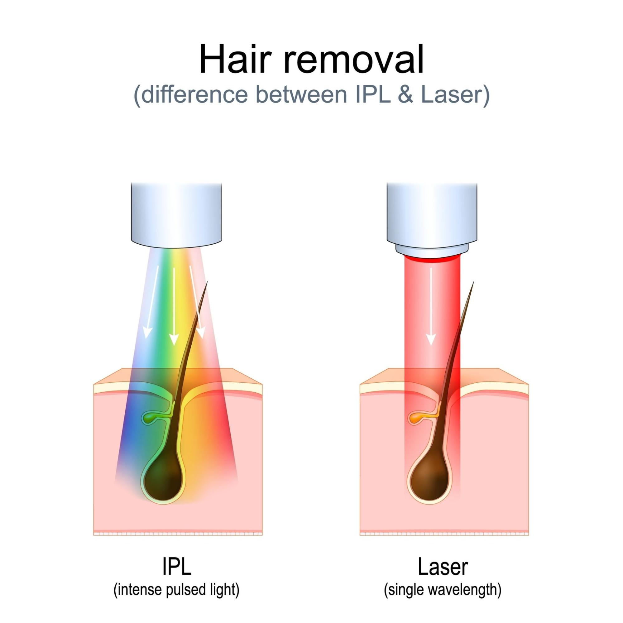 Difference between IPL and laser