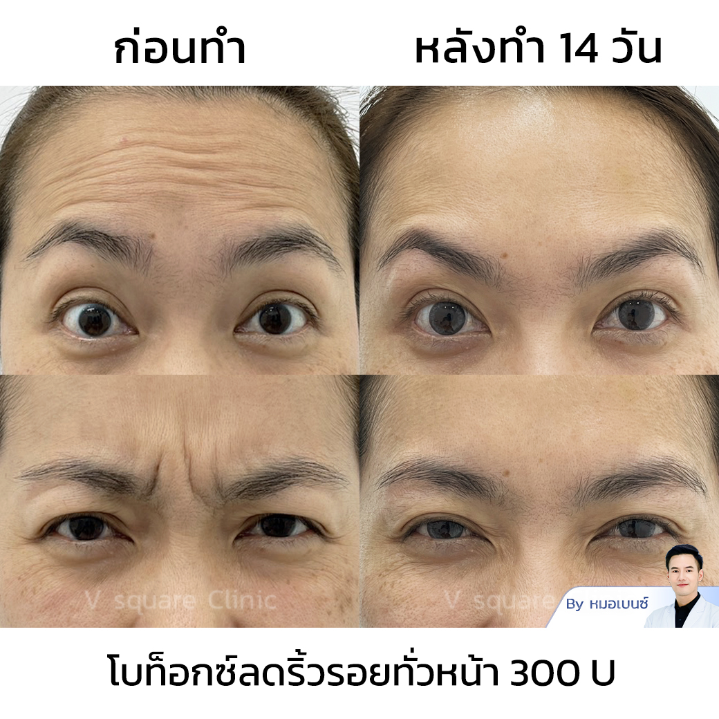 Dysport Botox wrinkle reduction review_คุณจุฑามาศ โดย หมอเบนซ์