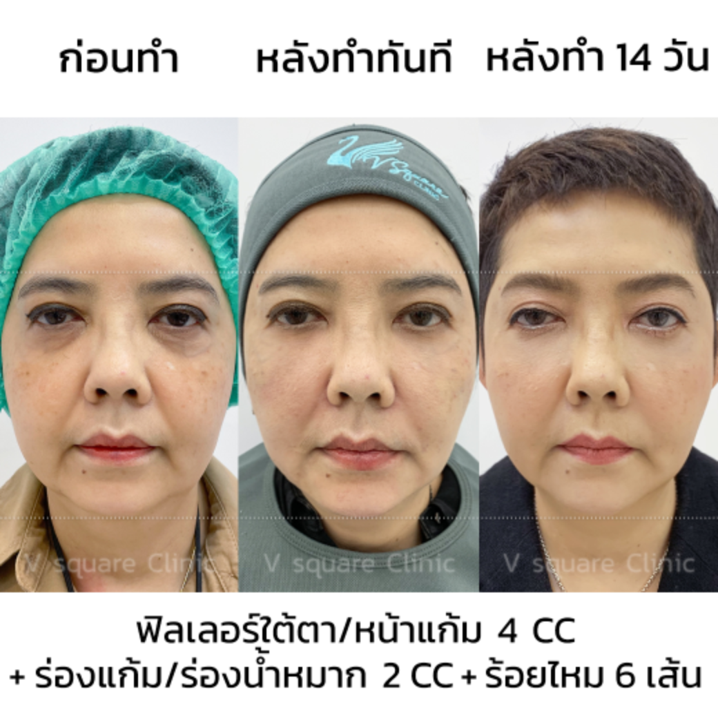 Facial lifting review_พี่ยุ้ยผจก.พี่ตุ้ย