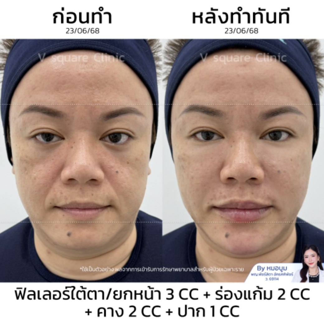 Filler facial lifting review_ คุณปาย (แบบเบสๆ) โดย หมอบูม