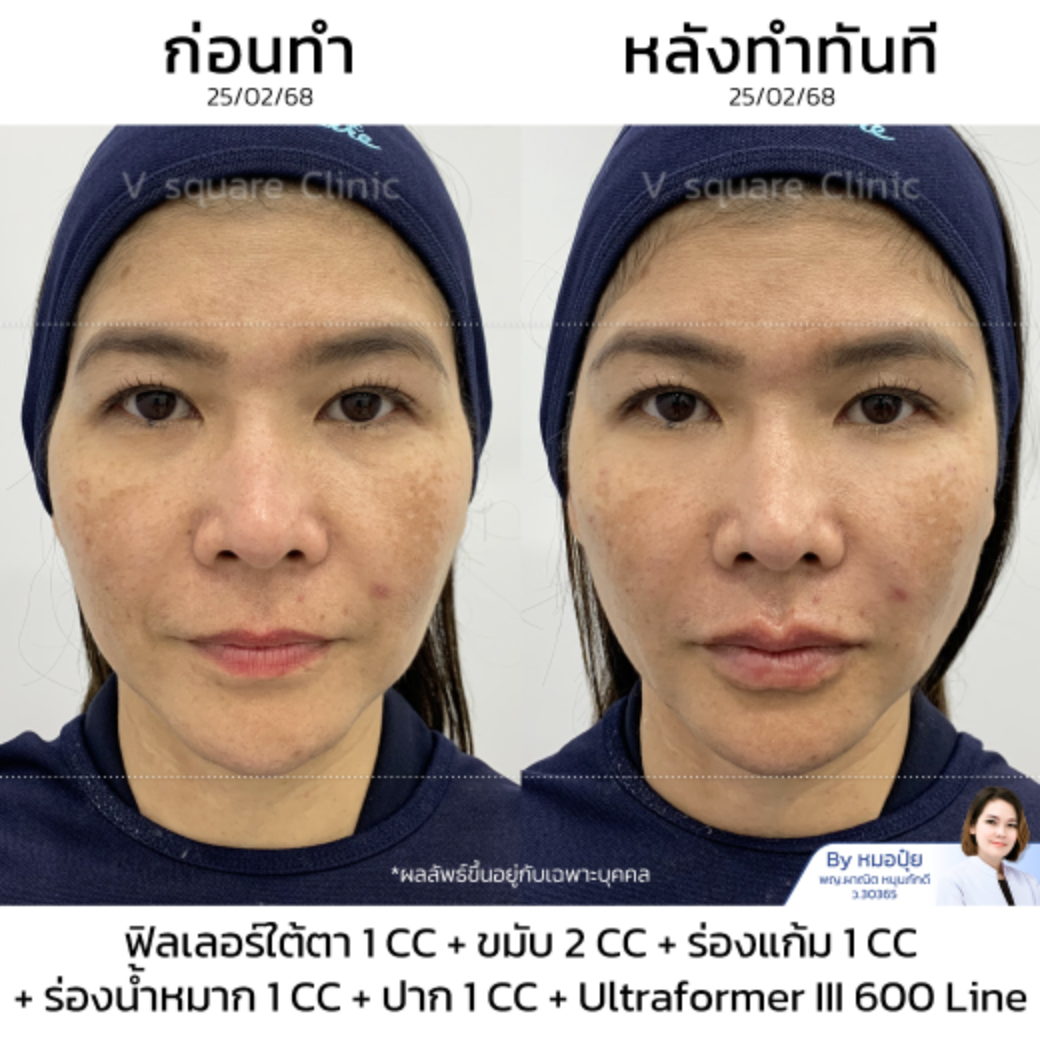 Filler facial lifting review_คุณหมวย โดย หมอปุ้ย