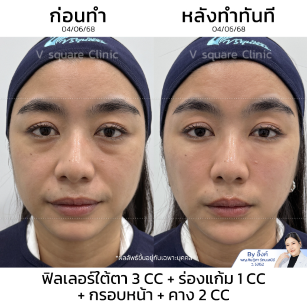 Filler facial lifting review_คุณอิ้งค์ (แบบเบสๆ) โดย หมอ อิ้งค์