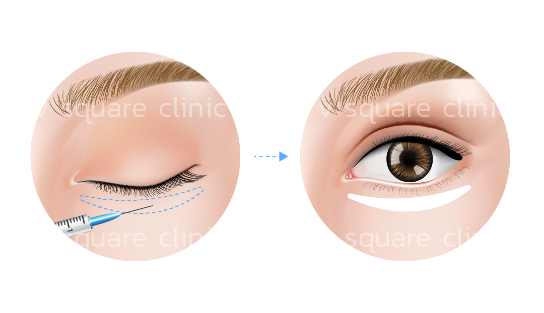 Filler – Dolly Eyes