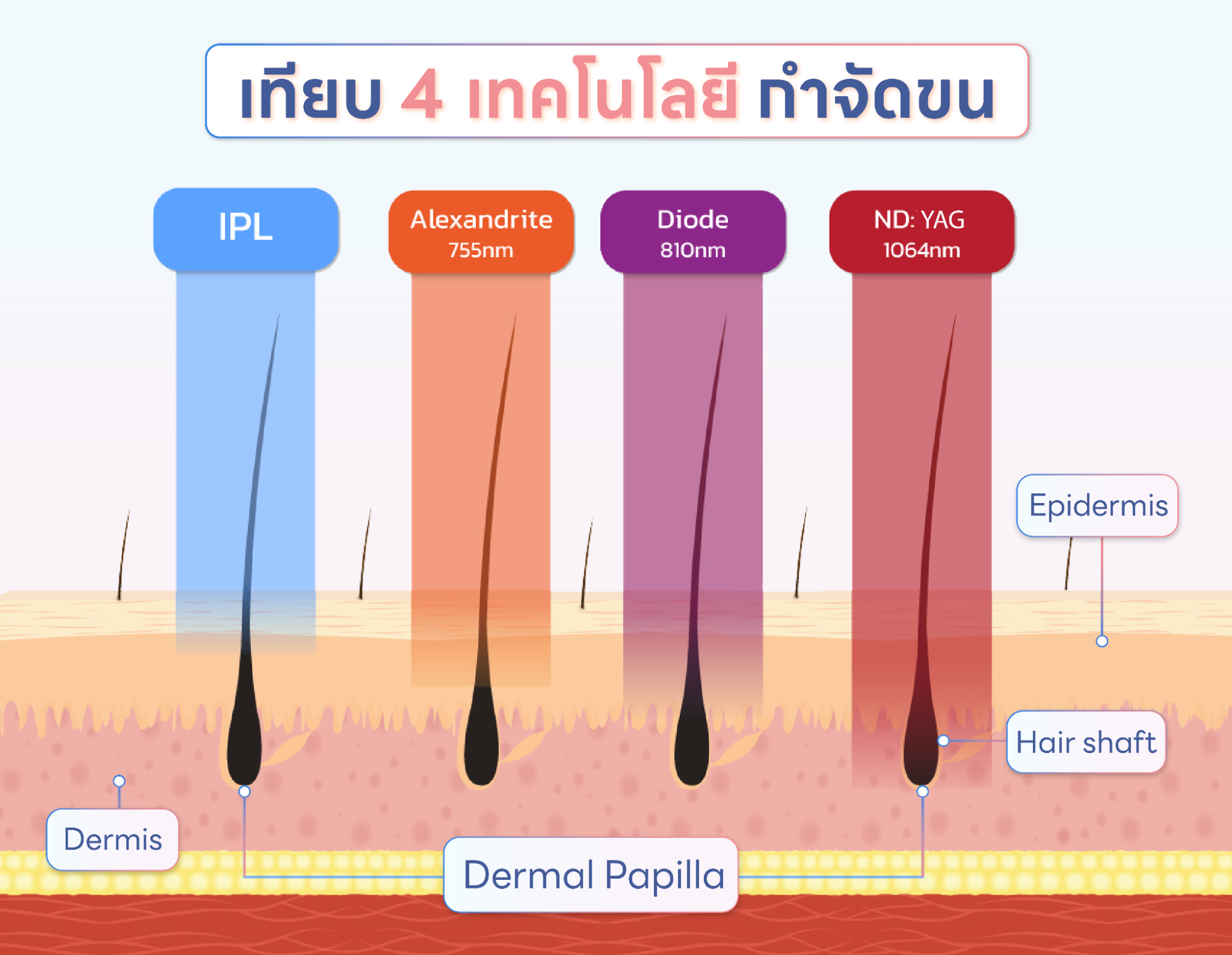 Hair removal laser comparison