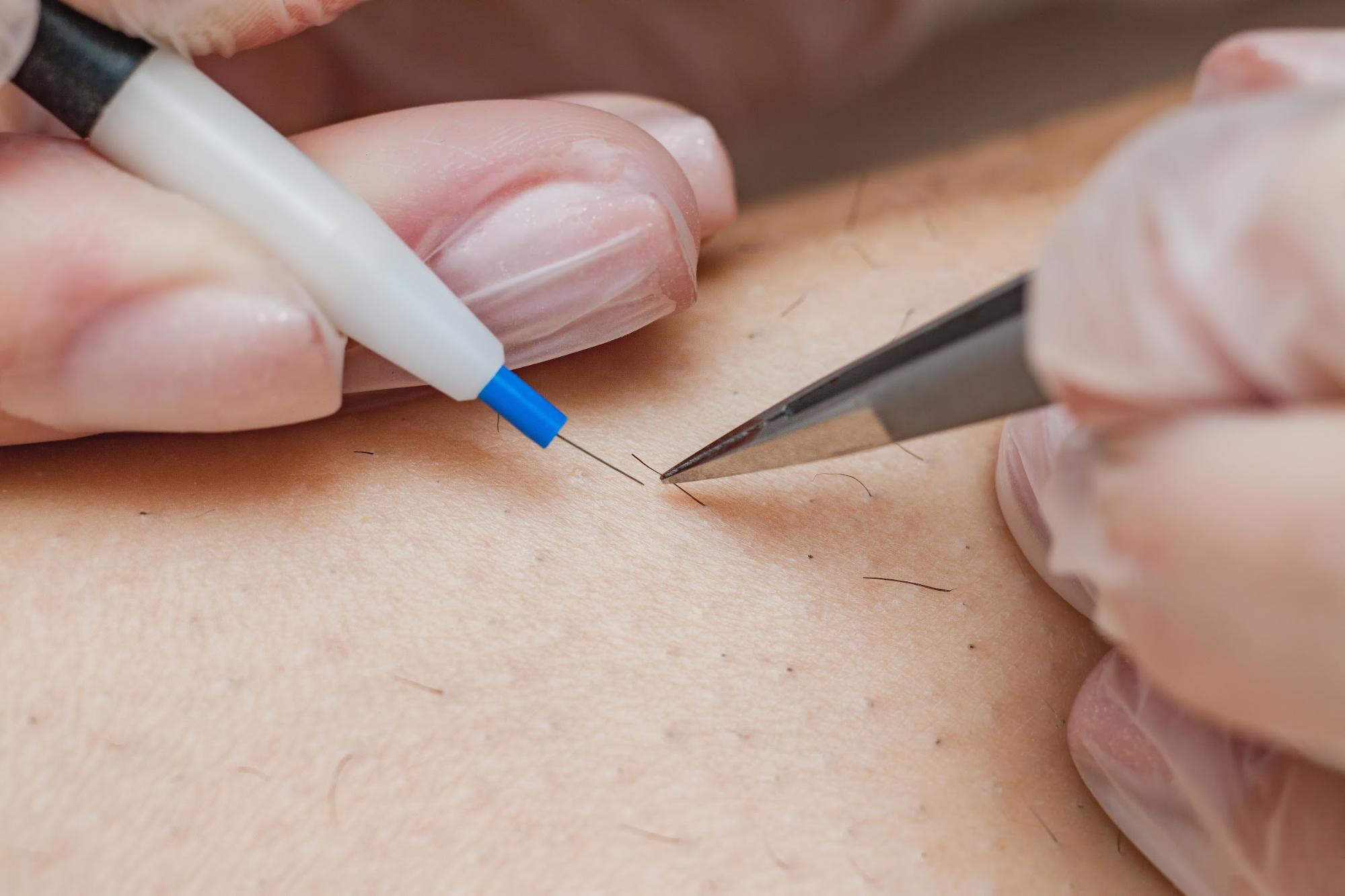 Hair removal with electrolysis