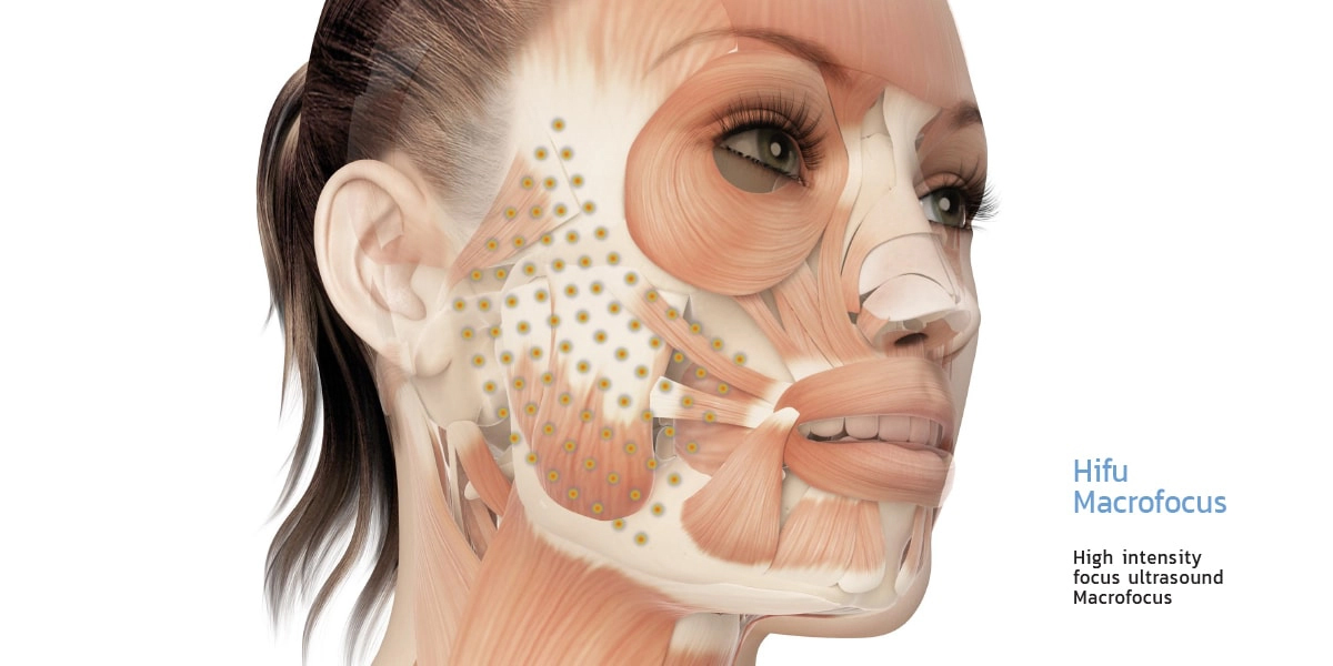 High-intensity focus ultrasound Macrofocus
