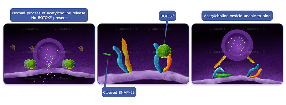 Who is suitable for Botox wrinkle reduction