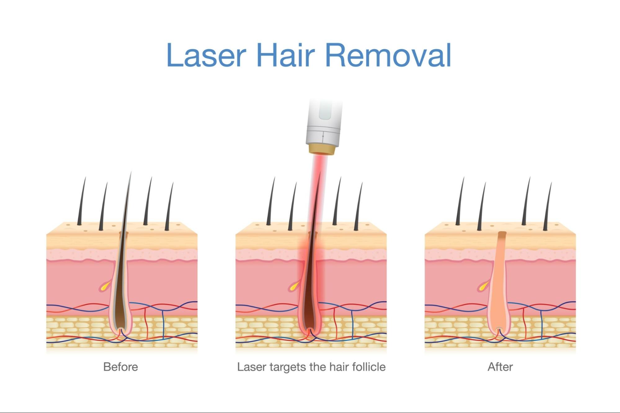 How laser hair removal works