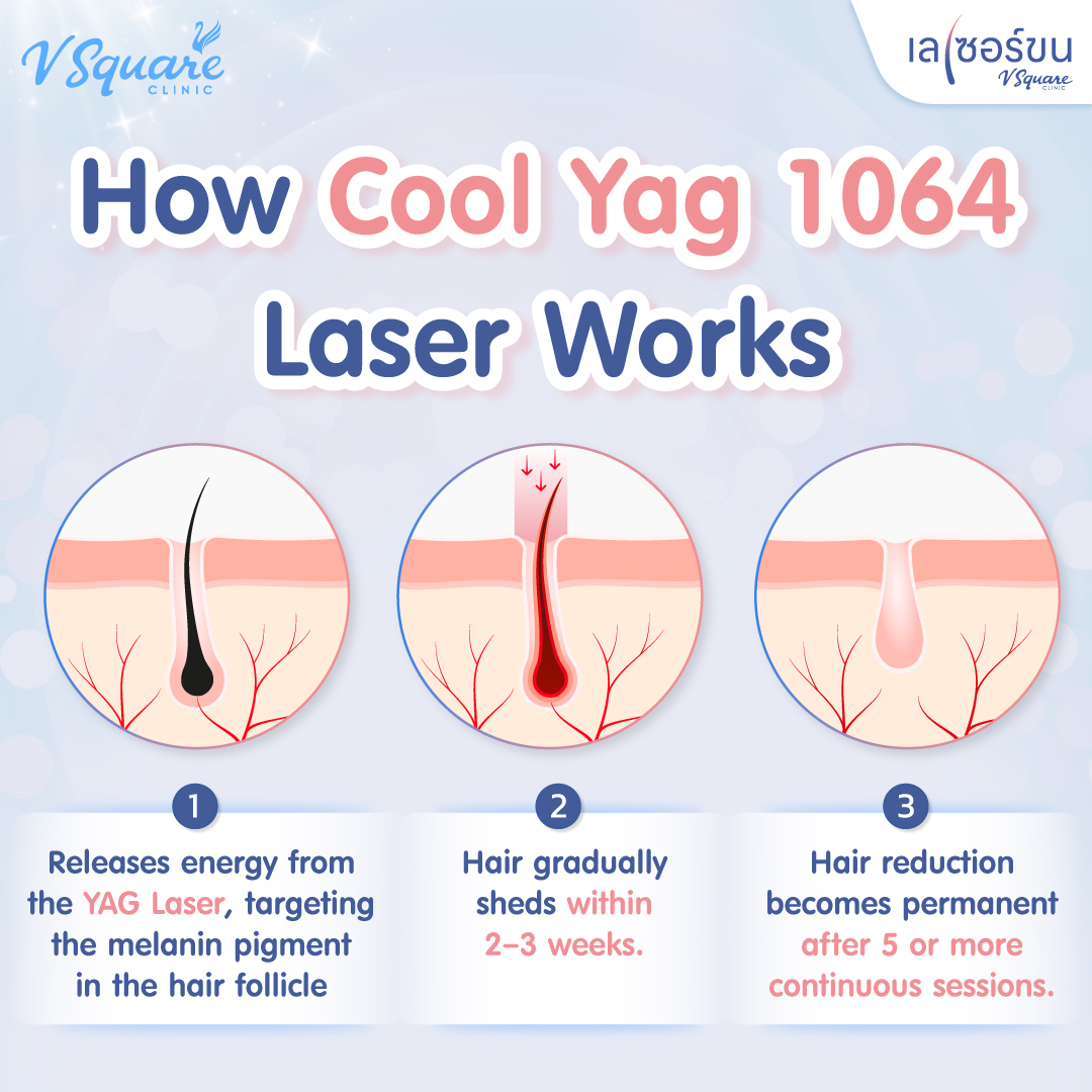 How the underarm laser works
