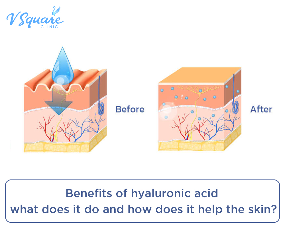 Hyaluronic Acid