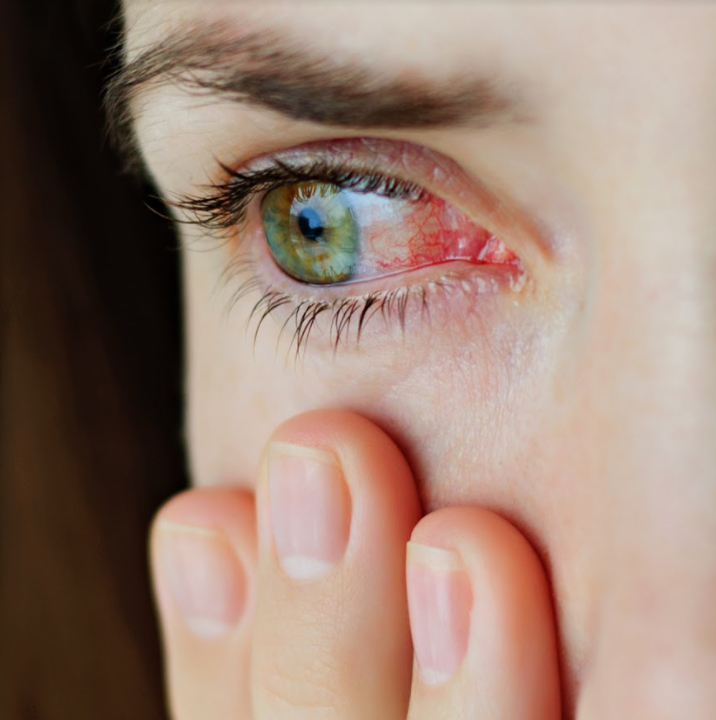 Hyaluronic acid relieves dry eyes