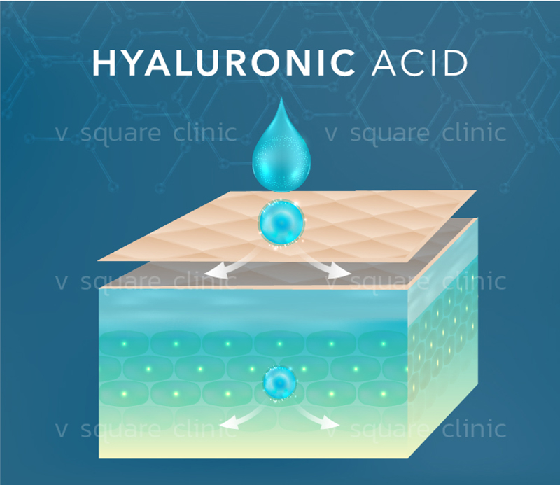 Hyaluronic acid restores the skin