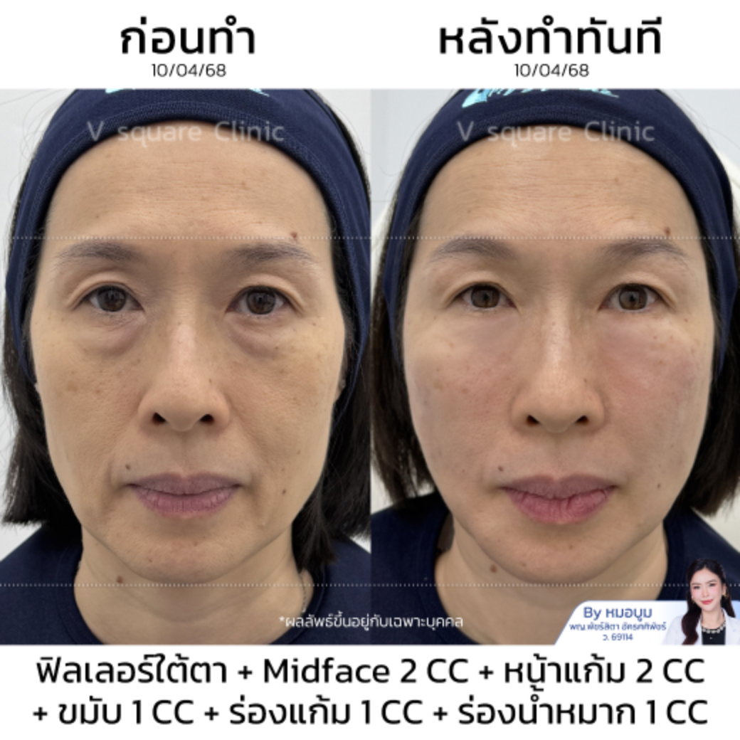 Injectable facial lifting review_คุณพลอย (แบบเบสๆ) โดย หมอบูม