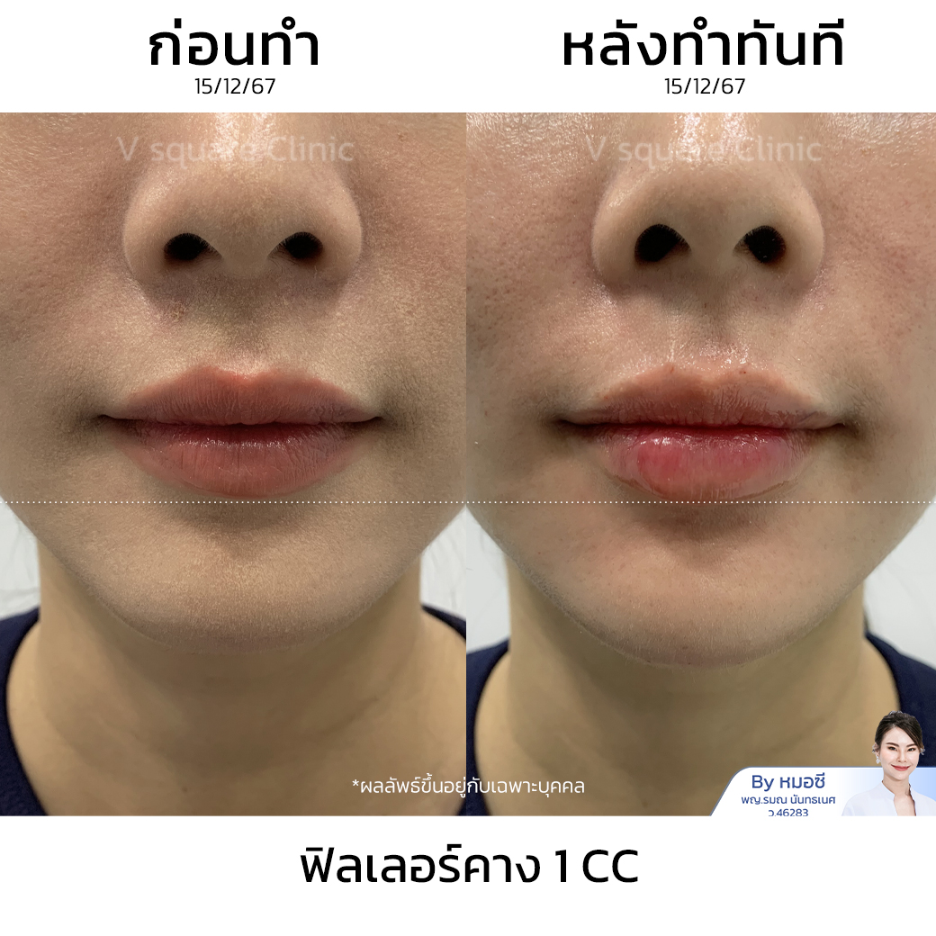Juvederm Volux review_คุณกุ๊กกิ๊ก โดย หมอซี