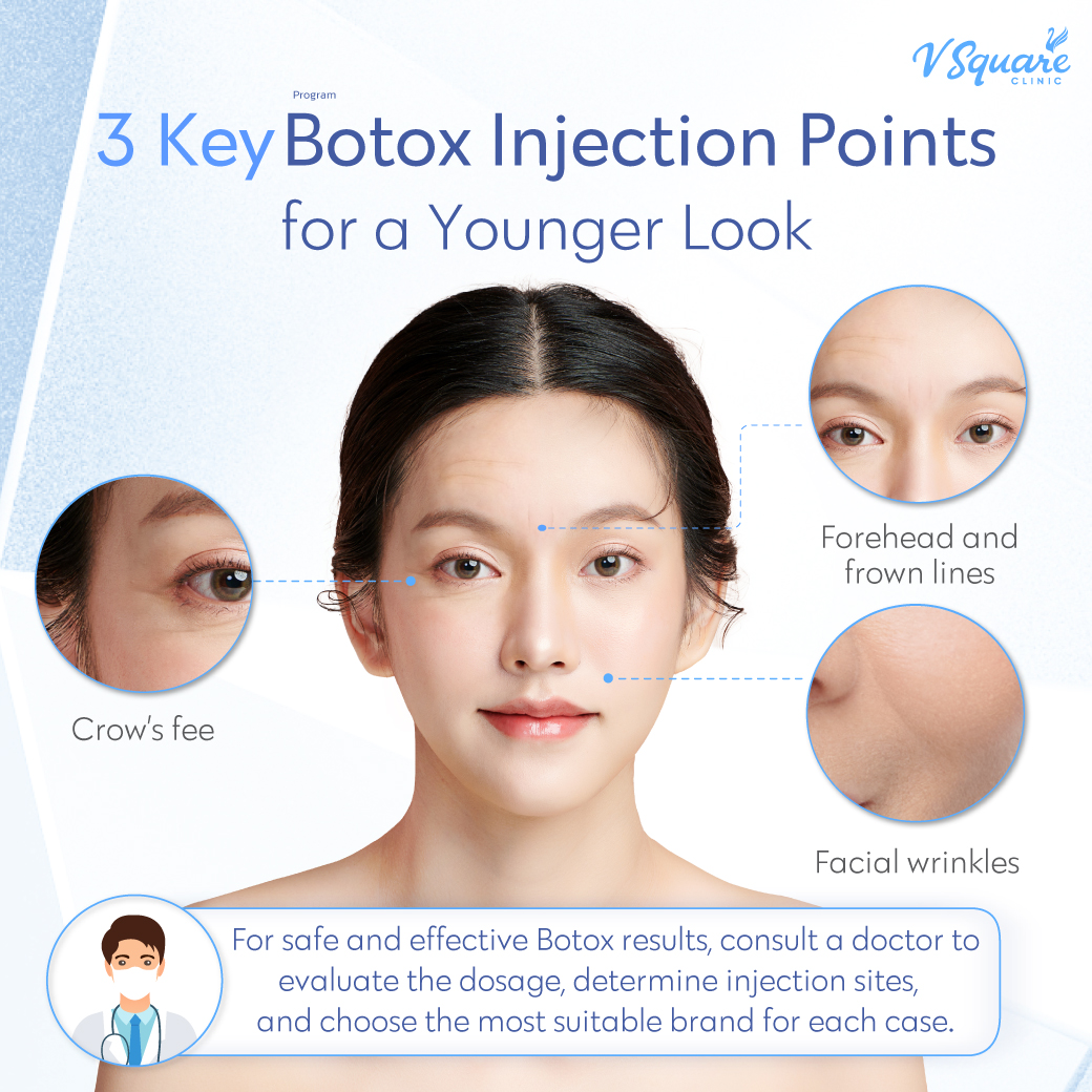 Key Botox injection points for wrinkle reduction